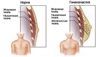 Увеличение и коррекция контуров мужской груди (пекторальные имплантаты)